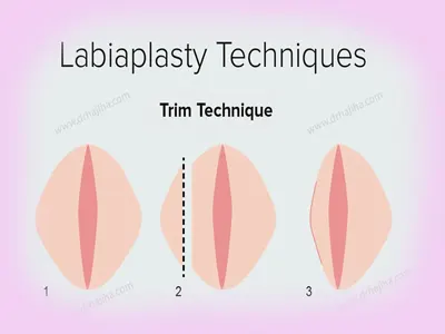 تکنیک-Trim-Technique