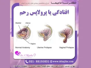 افتادگی رحم