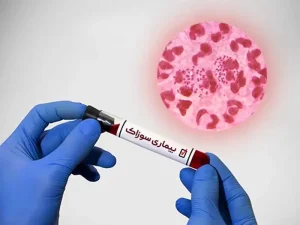 بیماری سوزاک