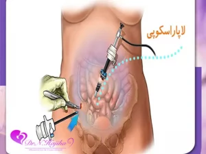لاپاراسکوپی