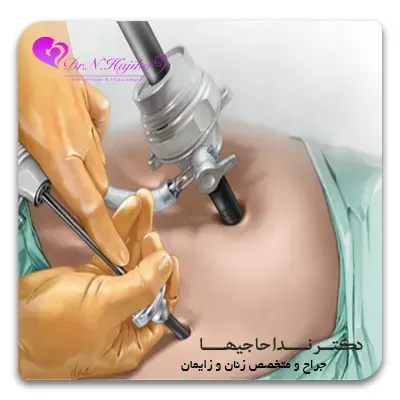 لاپاراسکوپی بهتر است یا جراحی باز؟