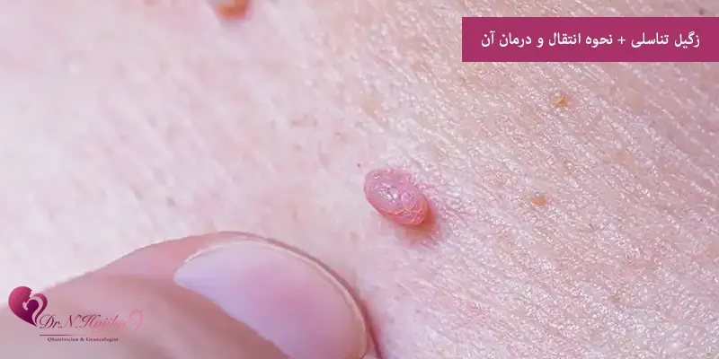 زگیل تناسلی + نحوه انتقال و درمان آن
