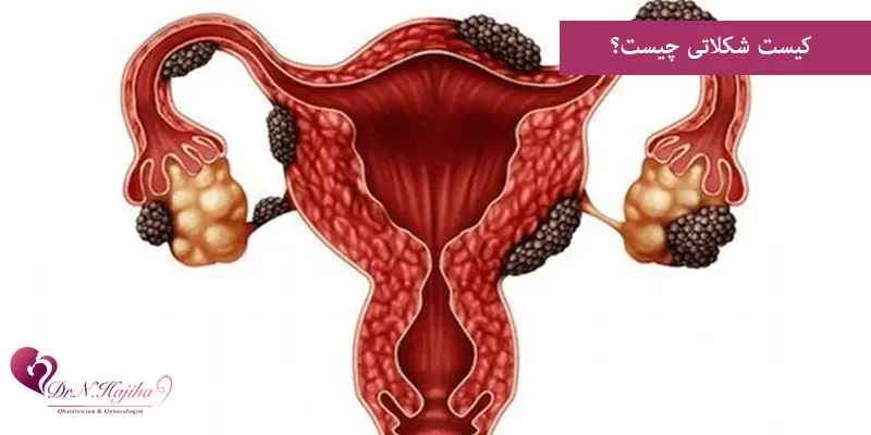 کیست شکلاتی چیست؟